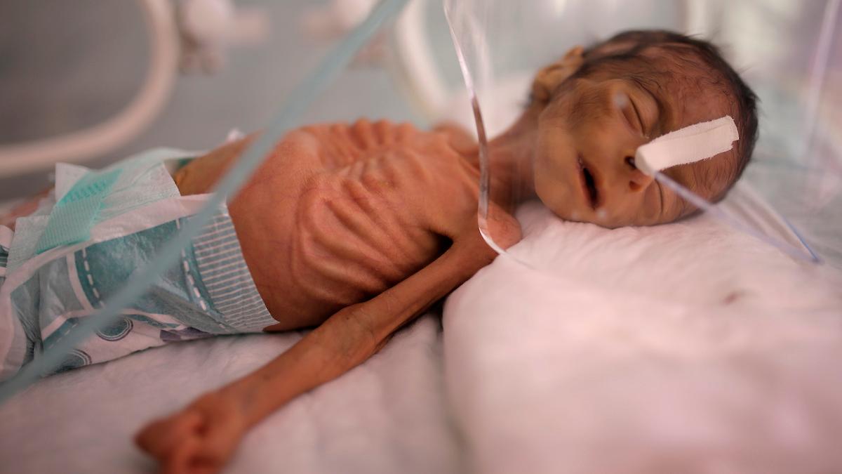 Ett undernärt nyfött spädbarn i Jemen, ett av de länder där människor dog av svält under 2022, enligt en rapport från EU och FN