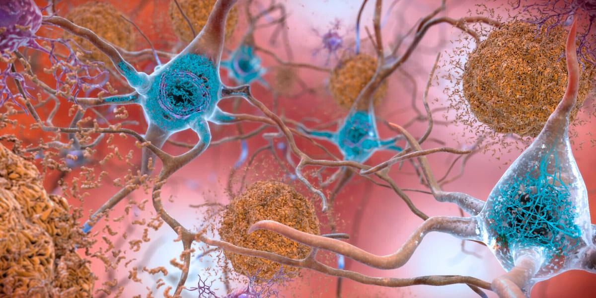 Celler i en hjärna med Alzheimers med onormala nivåer av beta-amyloidprotein som klumpar ihop sig och bildar bruna plack