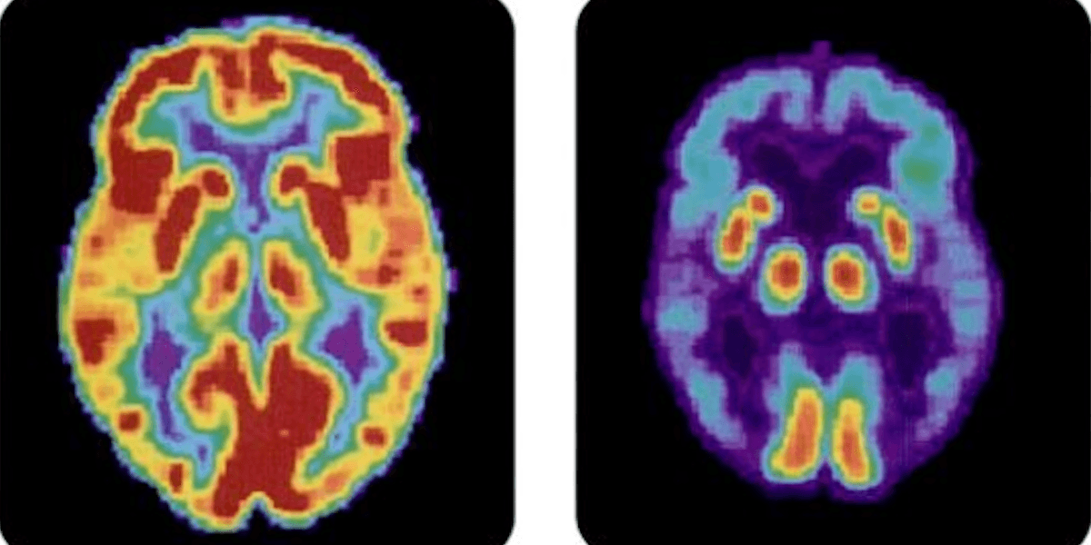PET-bild av en normal hjärna till vänster och en hjärna med Alzheimers sjukdom, till höger