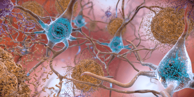 Plack i hjärnan. I en hjärna som drabbats av Alzheimers sjukdom klumpar onormala nivåer av proteinet beta-amyloid ihop sig och bildar plack, i brunt på bilden, placken samlas mellan neuroner och stör cellfunktionen