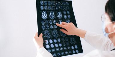 En läkare tittar på MRI-bilder av hjärnan. En ny rapport visar att det går att förebygga hjärnans sjukdomar
