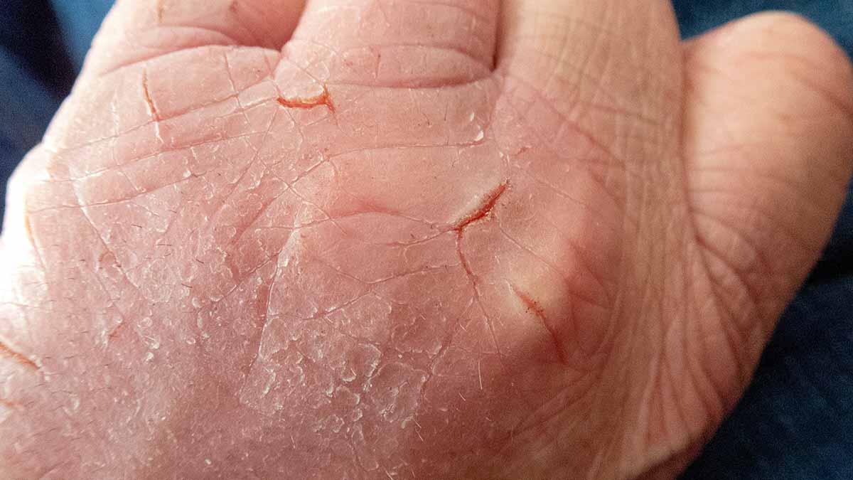 Google lanserar det AI-baserade verktyget Derm Assist för självdiagnostisering av hudsjukdomar