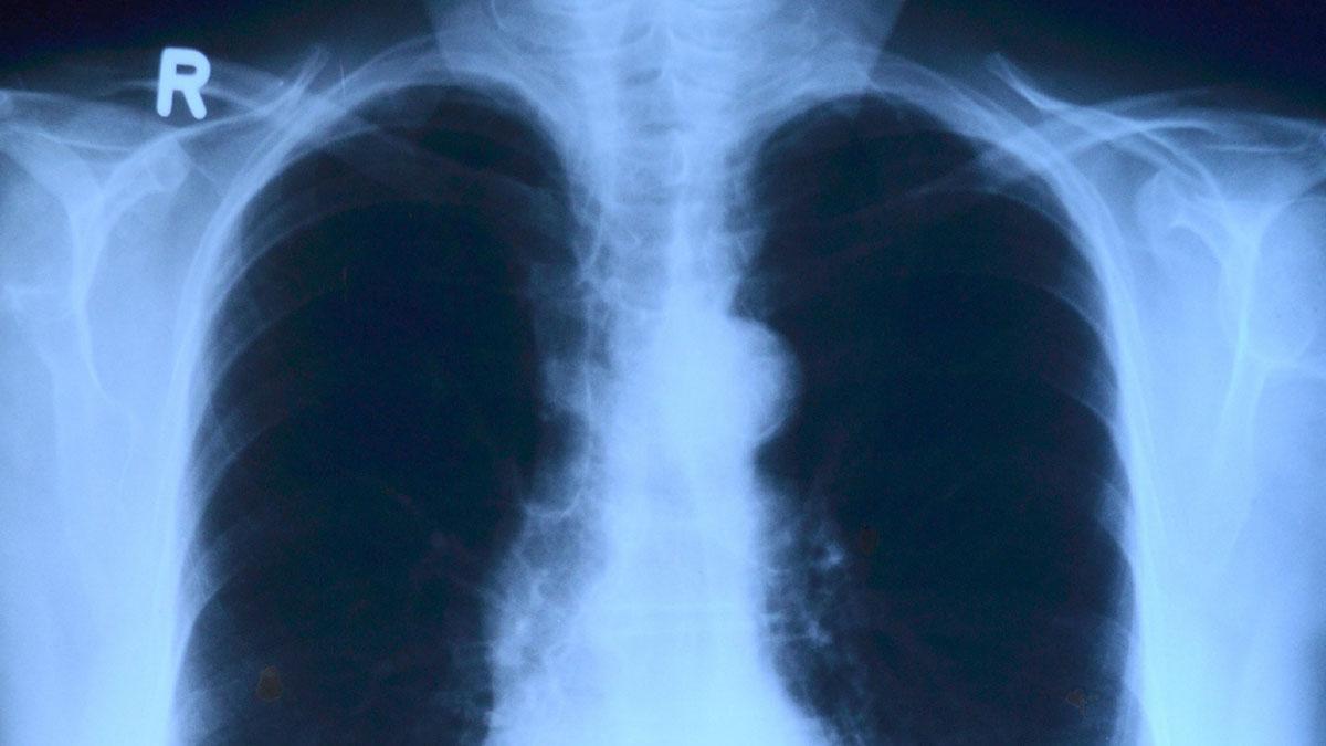 Saga Diagnostics samarbetar med UCL om lungcancer