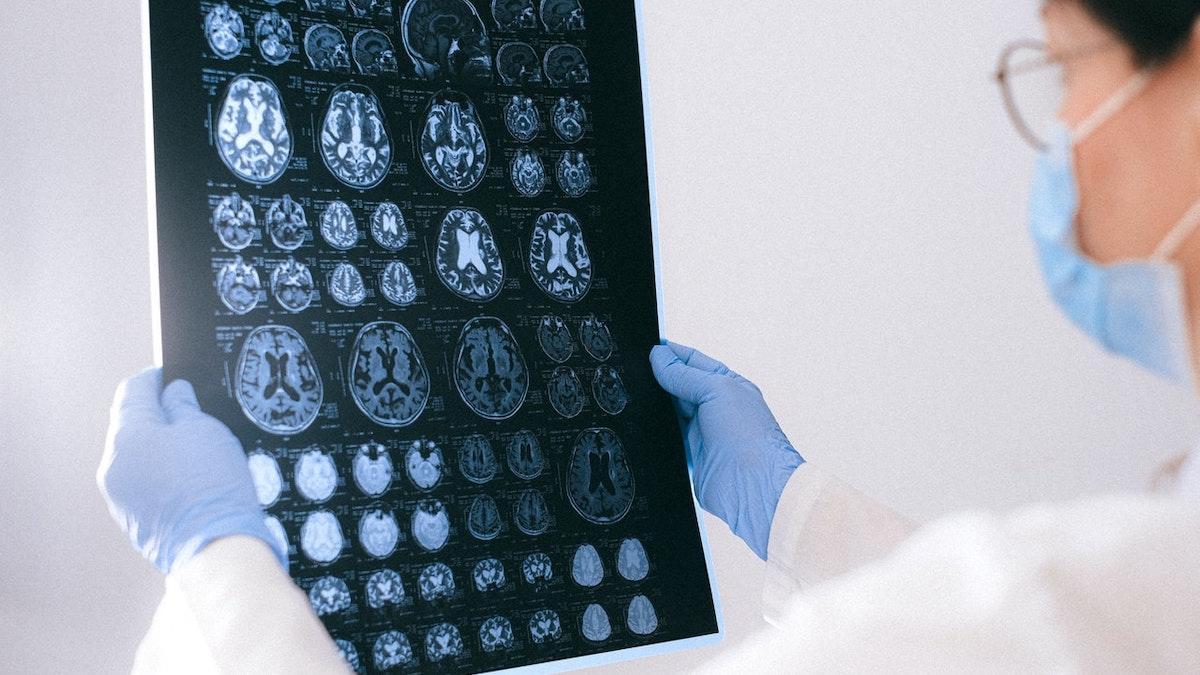 studie om överlevnad i hjärntumör