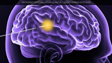DNy metod som tar bort tumörer med hjälp av laser