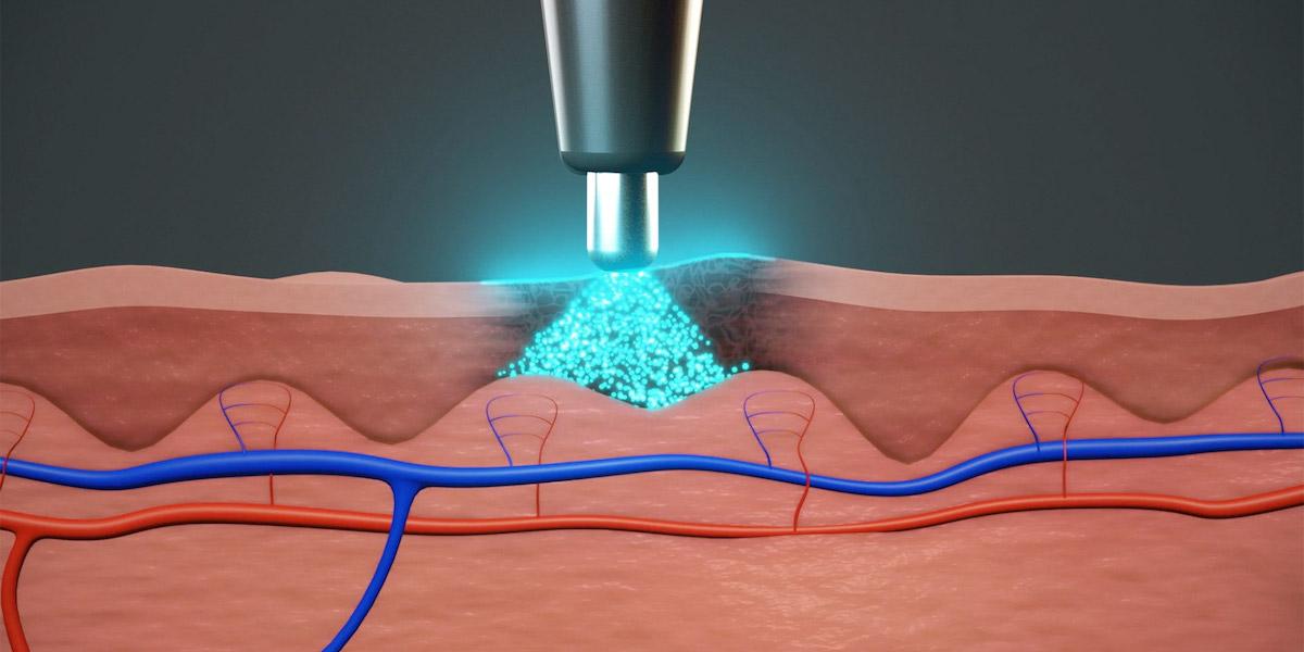 Derma Sensor upptäcker hudcancer med hjälp av ljus och artificiell intelligens