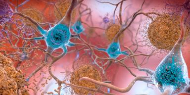 En ny AI-satsning ska bota Alzheimers.