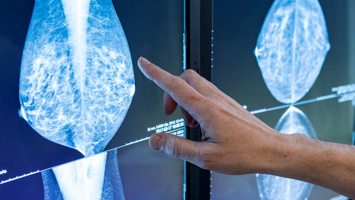 Astra Zenecas nya kompletterande ansökan för bröstcancerläkemedlet Lynparza har beviljats prioriterad granskning i USA