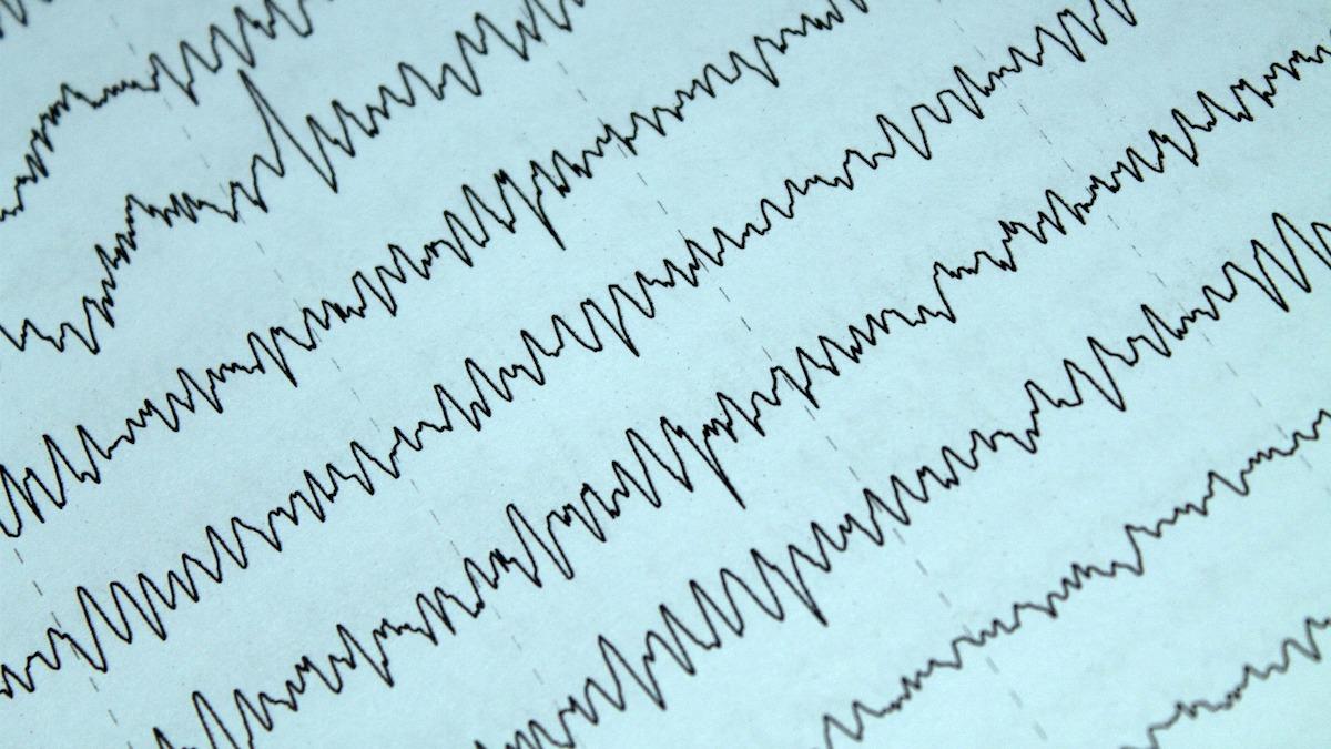 Neuroforskare har av misstag spelat in en döende hjärna med EEG när de undersökte en 87-årig man med epilepsi