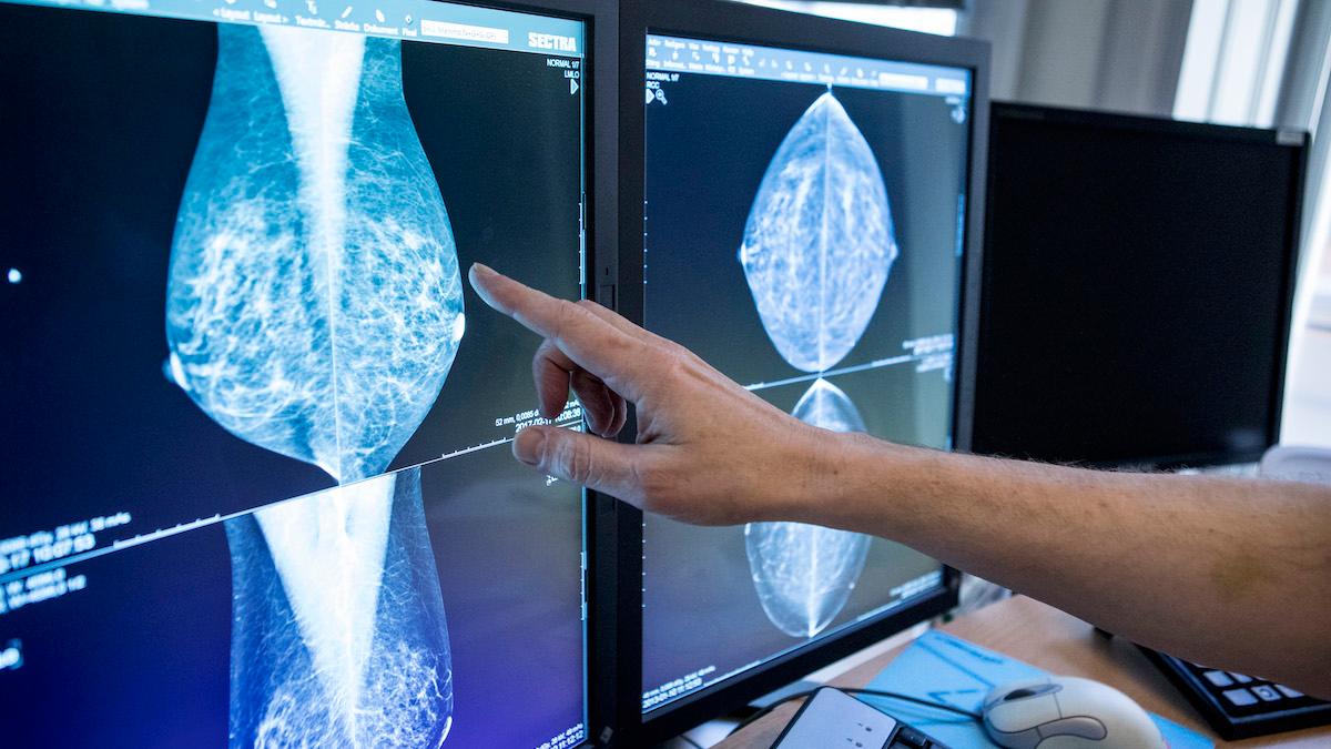 Ny forskning visar att innan en bröstcancertumör ens upptäcks kan celler som ännu inte är elakartade sprida sig till andra organ och ligga vilande.