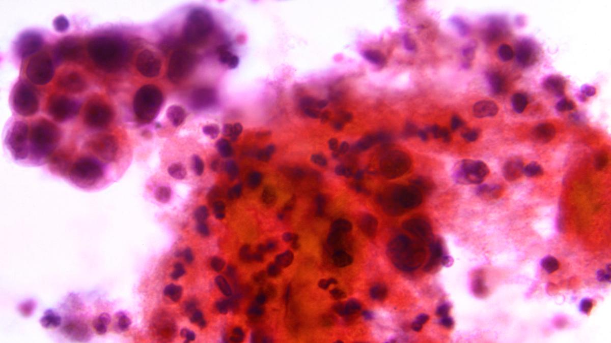 Cancerceller från ett gynekologiskt cellprov. Brittiska forskare utvecklar en metod att guida cancerdödande virus direkt till tumörer inne i kroppen så att de kan döda cancercellerna.