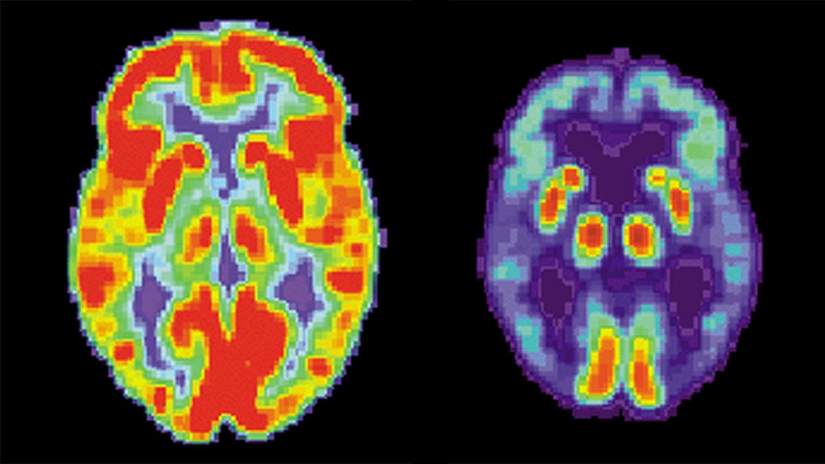 PET, positronemissionstomografi av en normal hjärna, till vänster, och en hjärna med Alzheimers sjukdom, till höger