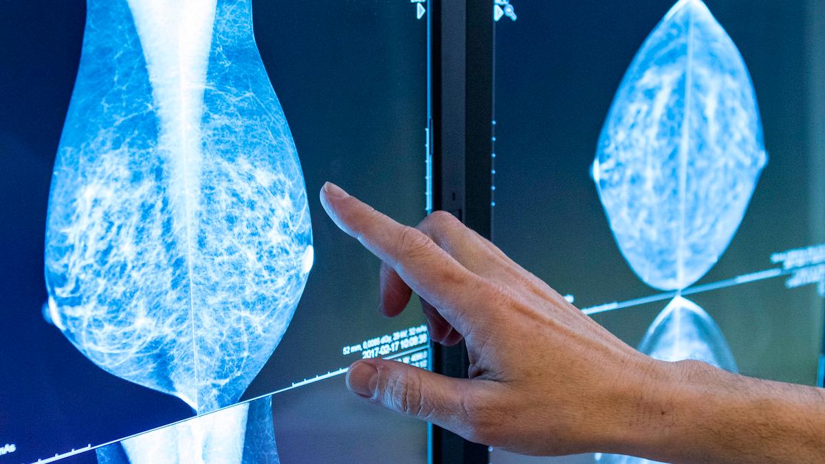 En ny studie visar att AI-stödd granskning av mammografibilder hittar fler fall av bröstcancer