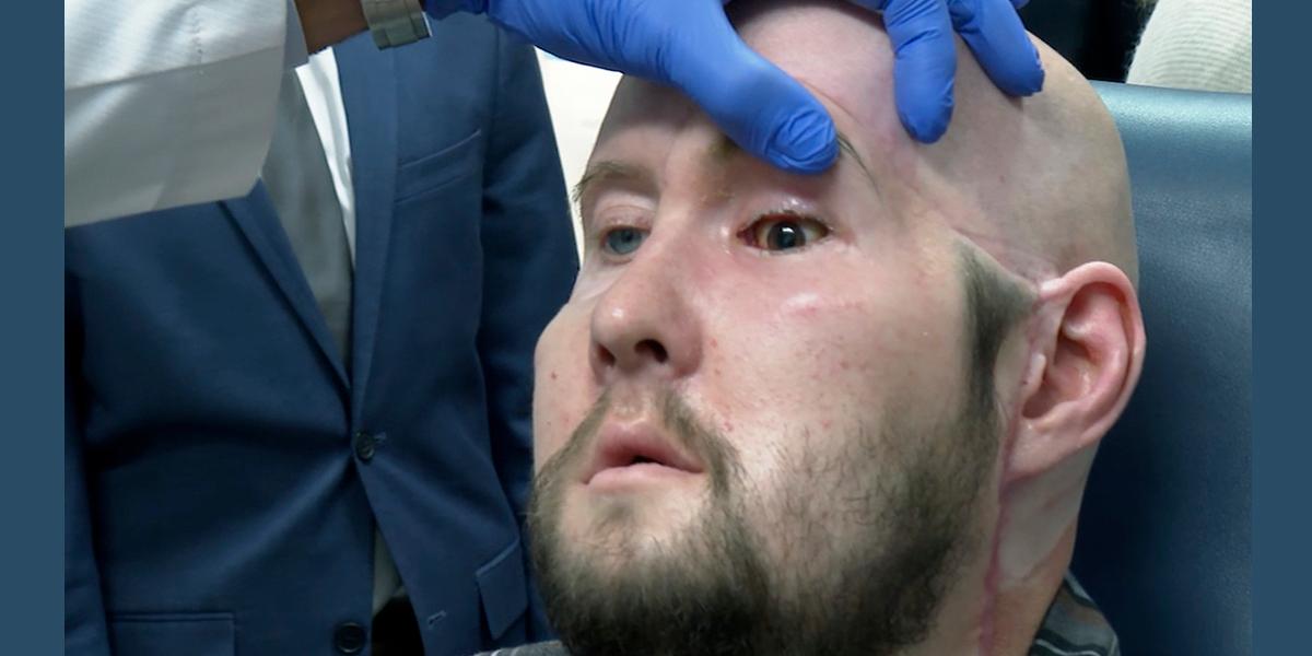 Läkaren Eduardo Rodriguez undersöker Aaron James transplanterade öga