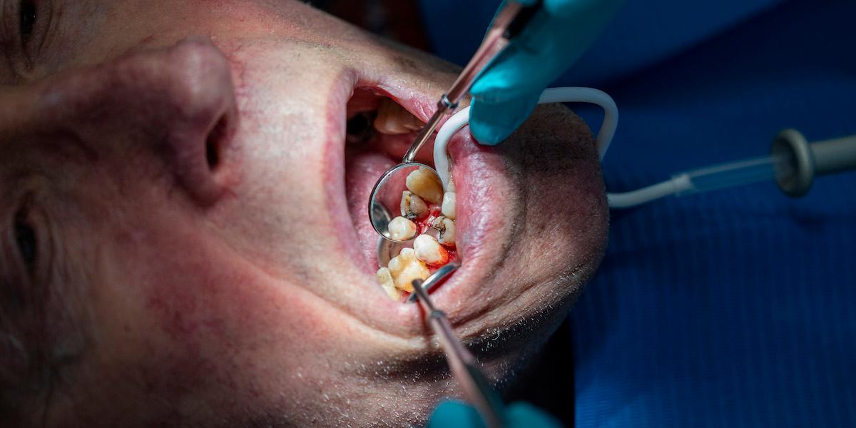 År 2019 fick Försäkringskassan möjligheten att stänga av tandvårdsföretag från det statliga tandvårdsstödet, nya siffror visar att många har stängts av sedan dess