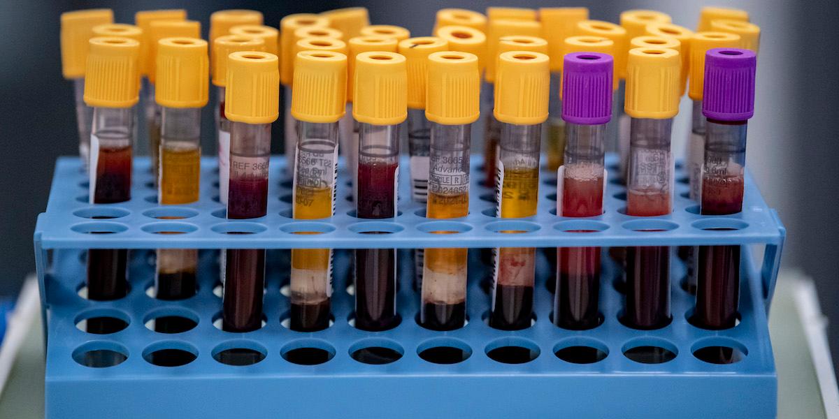 Forskare har identifierat förhöjda nivåer av ett vist protein hos patienter med postcovid, vilket skulle kunna göra det möjligt att ställa diagnos med ett blodprov