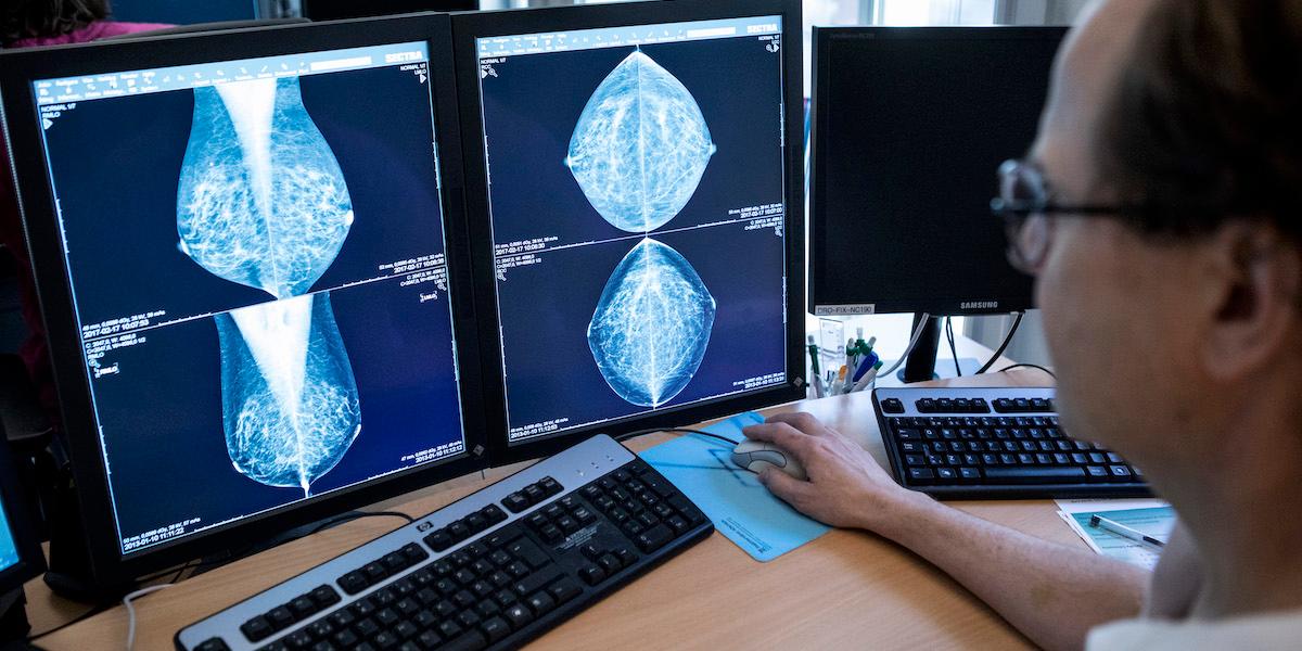 En läkare tittar på mammografibilder. En ny stor studie visar att nivån av immunceller påverkar risken för återfall i trippelnegativ bröstcancer